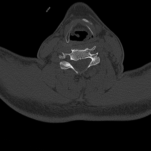 Cervical spine trauma with tear drop fracture and perched facet joint (Radiopaedia 53989-60127 Axial bone window 109).jpg