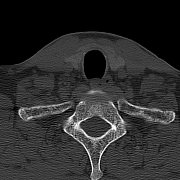 Cervical spondylodiscitis (Radiopaedia 28057-29489 Axial bone window 68).jpg