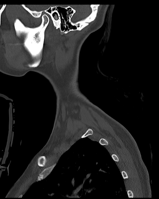 Cervical tuberculous spondylitis (Radiopaedia 39149-41365 Sagittal bone window 6).png