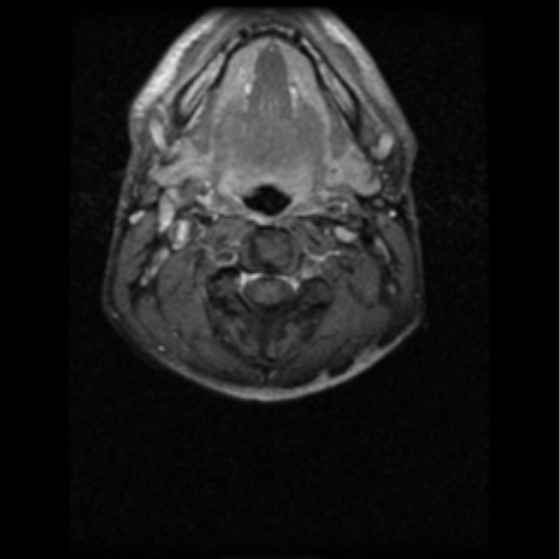 File:Cervical vertebrae metastasis (Radiopaedia 78814-91667 Axial T1 C+ fat sat 5).png