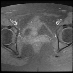 File:Cesarean scar ectopic pregnancy (Radiopaedia 77286-89362 Axial T1 fat sat 18).jpg