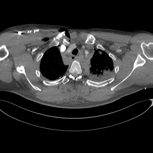 File:Chest multitrauma - aortic injury (Radiopaedia 34708-36147 A 57).png