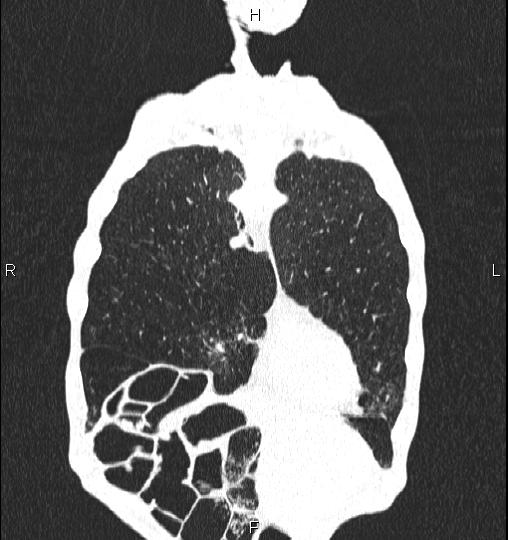 Chilaiditi sign (Radiopaedia 88839-105611 Coronal lung window 11).jpg