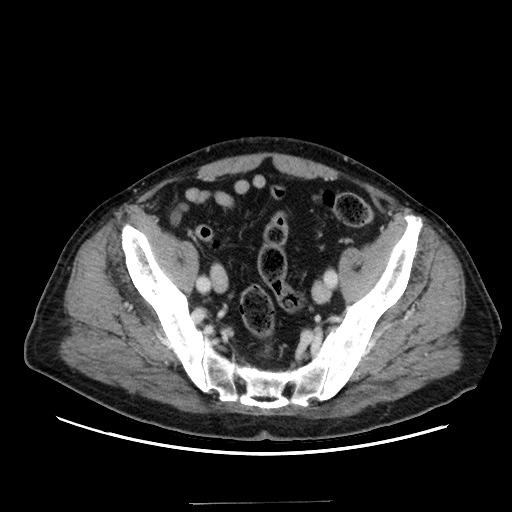 Choledocholiathiasis with normal caliber common bile duct (Radiopaedia 75368-86632 A 157).jpg