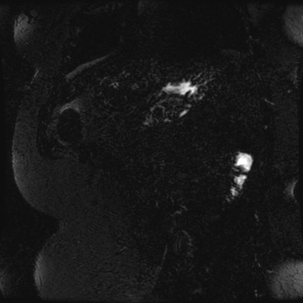 Choledocholithiasis on CT and MRI (Radiopaedia 24825-25088 Coronal T2 98).jpg