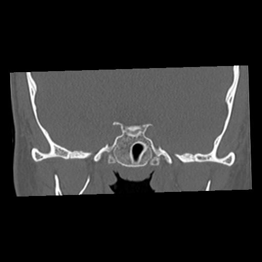Cholesteatoma (Radiopaedia 84960-100474 Coronal bone window 12).jpg