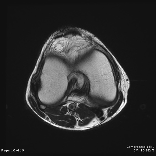 File:Chondroblastoma (Radiopaedia 25725-25891 Axial T2 10).jpg