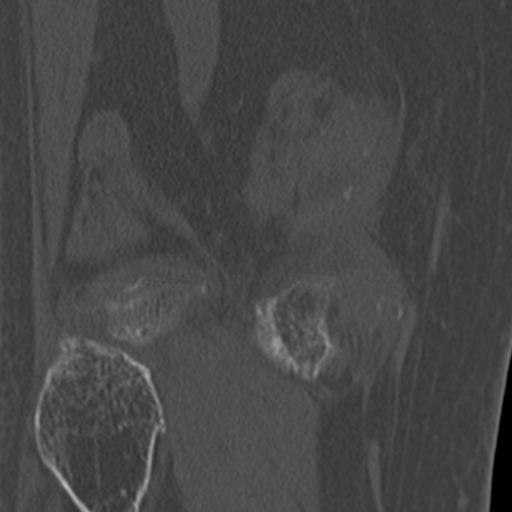 Chondrocalcinosis (Radiopaedia 16275-15955 Coronal bone window 46).jpg