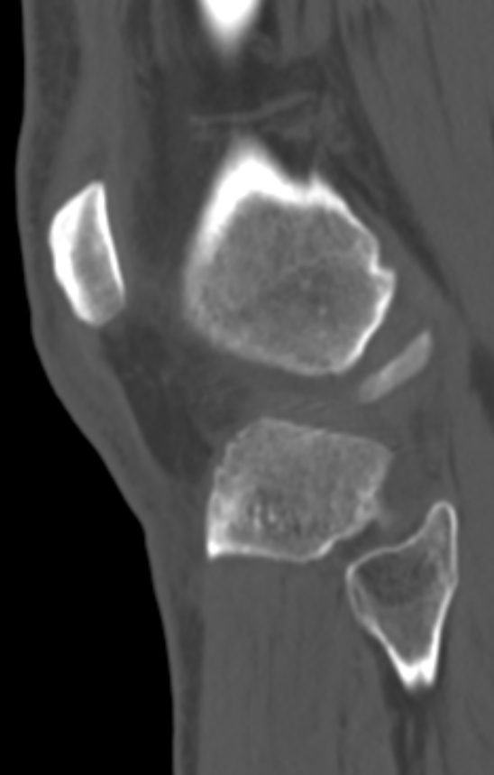 Chondrocalcinosis (Radiopaedia 82862-97173 Sagittal bone window 55).jpg