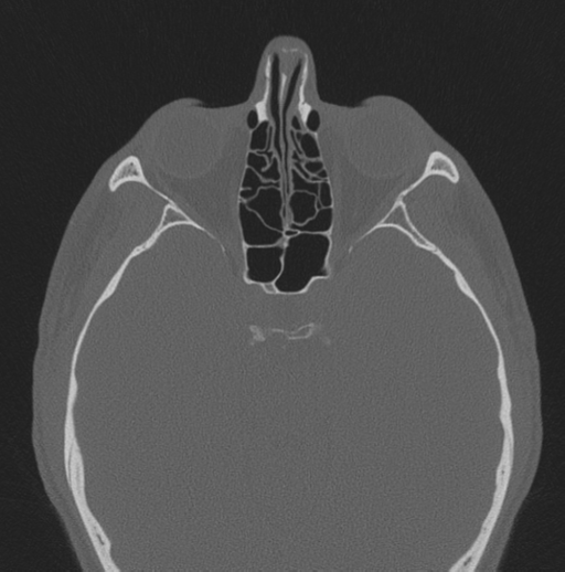 Chondrosarcoma (clivus) (Radiopaedia 46895-51425 Axial bone window 31).png