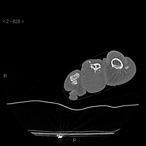 Chondrosarcoma - phalanx (Radiopaedia 69047-78812 Axial bone window 82).jpg