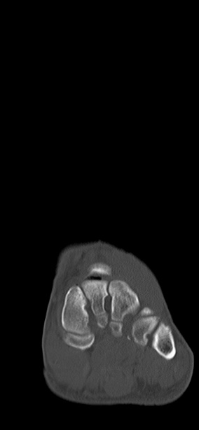 Chopart fracture (Radiopaedia 35347-36851 Coronal bone window 52).jpg