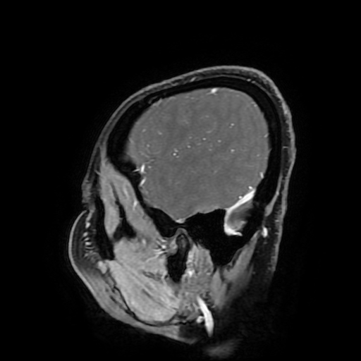File:Chordoid glioma of third ventricle (Radiopaedia 91612-109340 F 172).jpg