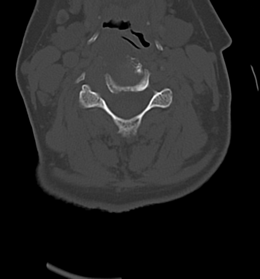 Chordoma (C4 vertebra) (Radiopaedia 47561-52188 Axial bone window 26).png