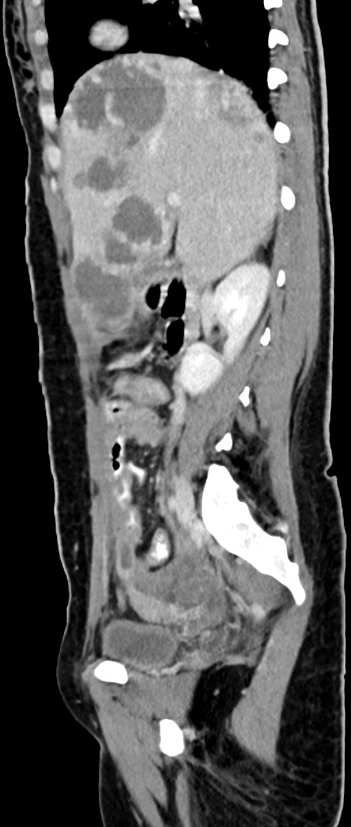 Choriocarcinoma liver metastases (Radiopaedia 74768-85766 C 115).jpg