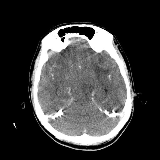 File:Choriocarcinoma of ovary with cerebral and pulmonary metastases (Radiopaedia 25983-26118 C+ arterial phase 62).jpg