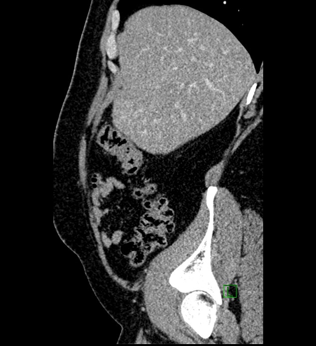 Chromophobe renal cell carcinoma (Radiopaedia 84286-99573 I 151).jpg