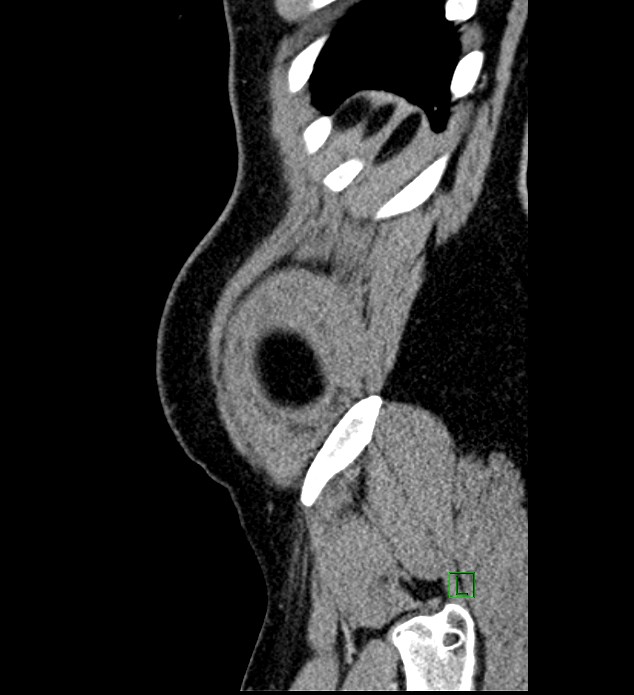 Chromophobe renal cell carcinoma (Radiopaedia 84286-99573 I 3).jpg