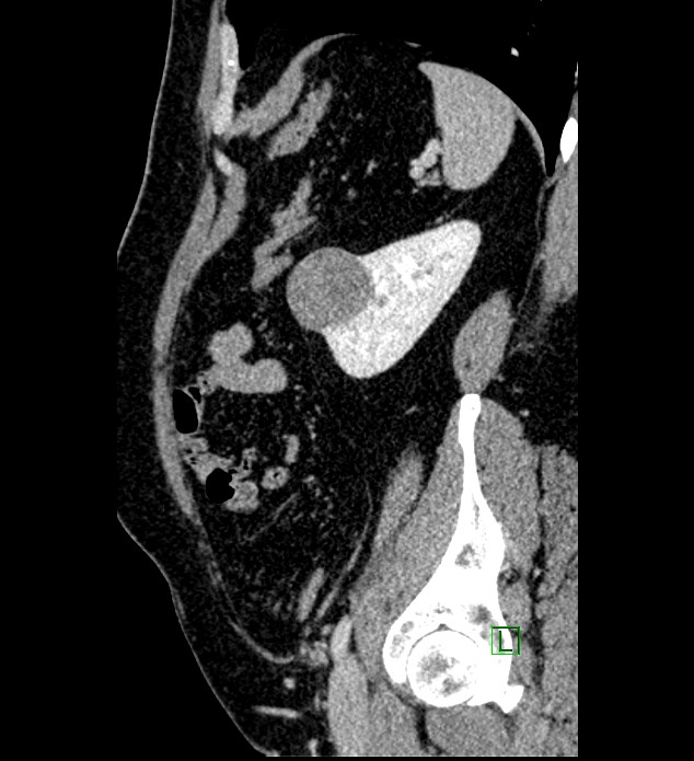 Chromophobe renal cell carcinoma (Radiopaedia 84286-99573 I 43).jpg