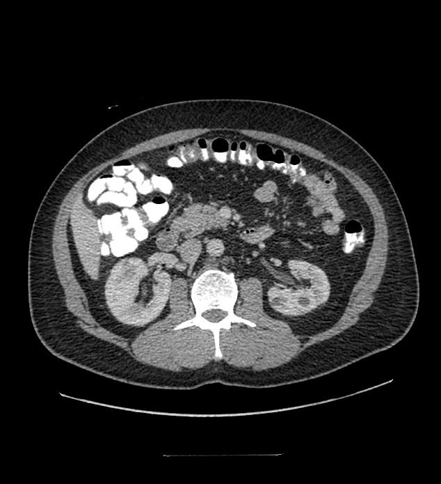 Chromophobe renal cell carcinoma (Radiopaedia 84337-99644 C 56).jpg