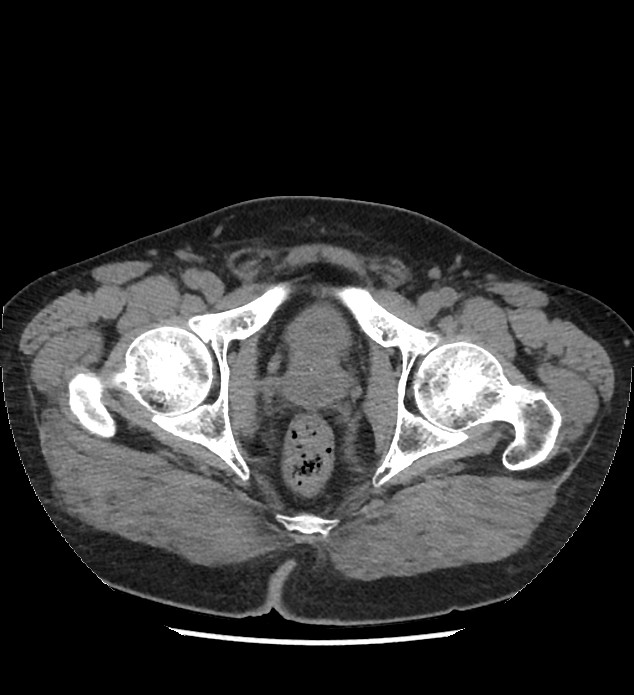 Chromophobe renal cell carcinoma (Radiopaedia 86879-103083 Axial non-contrast 128).jpg