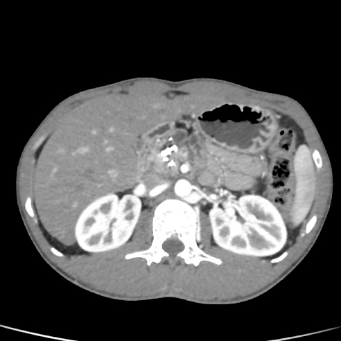 File:Chronic calcific pancreatitis (Radiopaedia 56280-62953 B 15).jpg