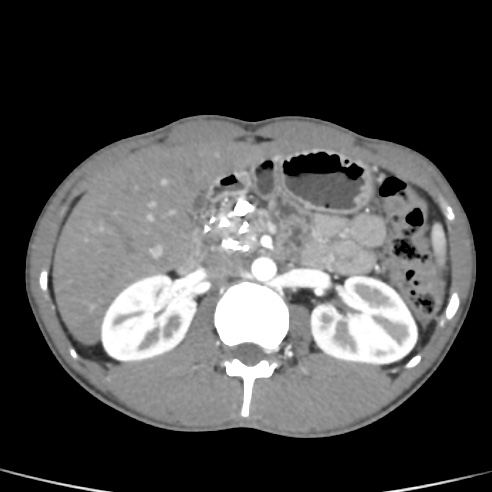 File:Chronic calcific pancreatitis (Radiopaedia 56280-62953 B 18).jpg