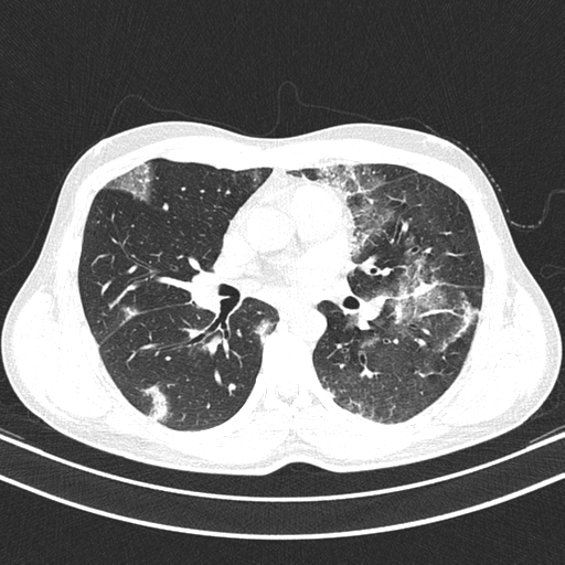 Chronic eosinophilic pneumonia (Radiopaedia 39331-41587 Axial lung window 25).png
