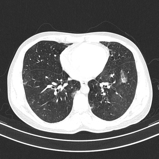Chronic eosinophilic pneumonia (Radiopaedia 39331-41587 Axial lung window 34).png