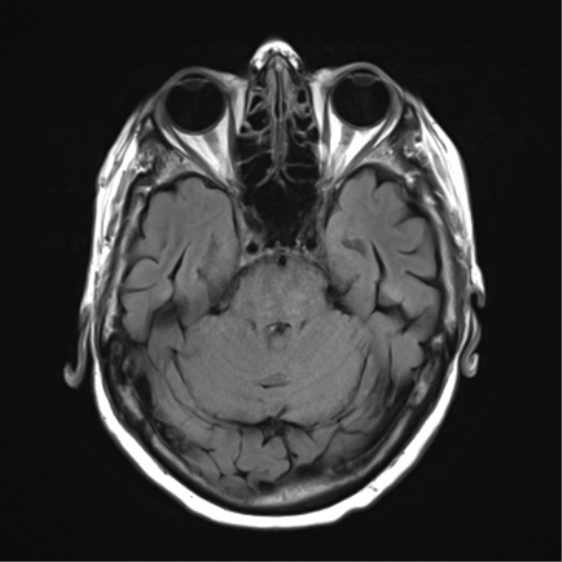 File:Chronic hypertensive encephalopathy (Radiopaedia 39993-42482 Axial FLAIR 8).png