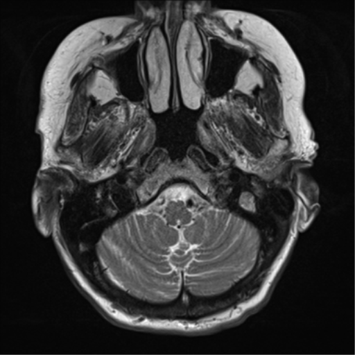 File:Chronic hypertensive encephalopathy (Radiopaedia 72844-83495 Axial T2 5).png