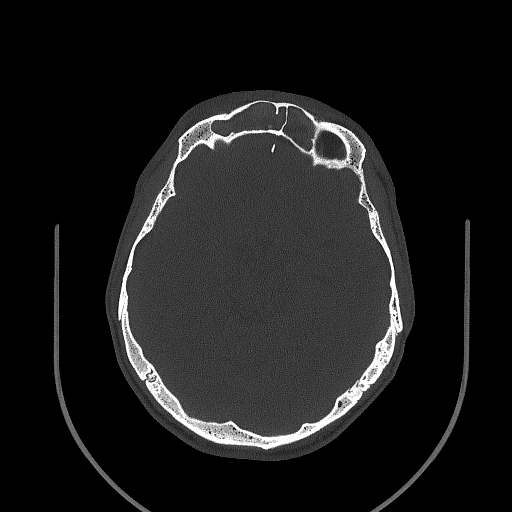 Chronic invasive fungal sinusitis (Radiopaedia 50342-55710 Axial bone window 112).jpg