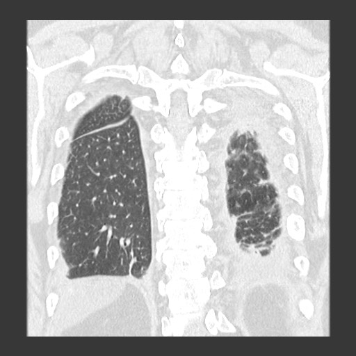 Chronic lung allograft dysfunction - restrictive form (Radiopaedia 60595-68316 Coronal lung window 78).jpg
