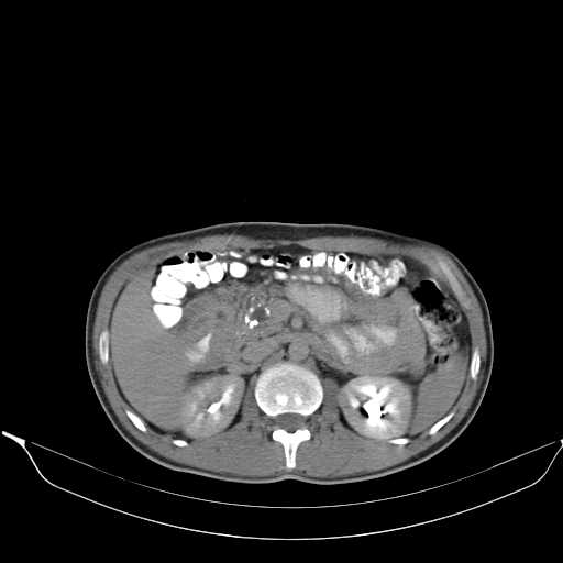 File:Chronic pancreatitis (Radiopaedia 21022-20949 Axial C+ delayed 25).jpg