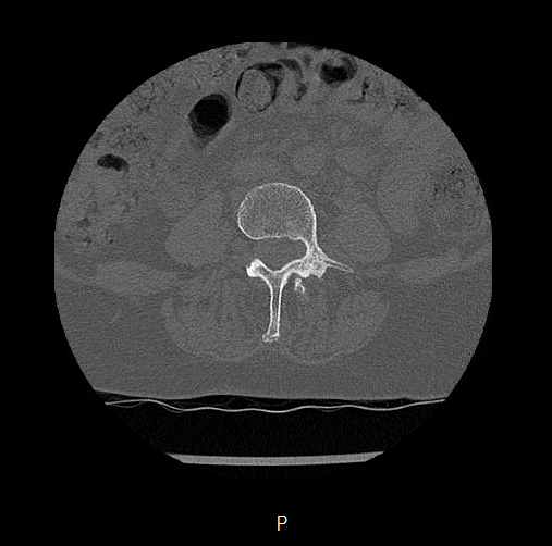 Chronic spinal hematoma with cauda equina syndrome (Radiopaedia 75745-88197 Axial bone window 29).png