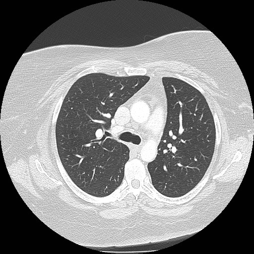 Cicatrisation collapse (Radiopaedia 17405-17089 lung window 43).jpg