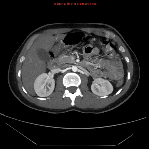 File:Circumaortic left renal vein (Radiopaedia 9069-9792 A 18).jpg
