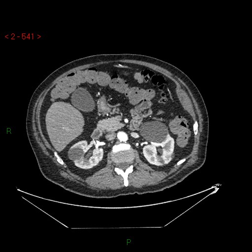 File:Circumaortic left renal vein and doubled left renal arteries (Radiopaedia 52268-58158 A 77).jpg