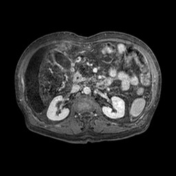Cirrhosis and hepatocellular carcinoma in the setting of hemochromatosis (Radiopaedia 75394-86594 Axial T1 C+ fat sat 282).jpg
