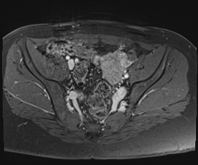 File:Class II Mullerian duct anomaly- unicornuate uterus with rudimentary horn and non-communicating cavity (Radiopaedia 39441-41755 Axial T1 fat sat 39).jpg