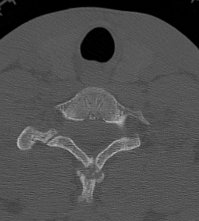 Clay-shoveler fracture (Radiopaedia 14604-14532 Axial bone window 36).jpg