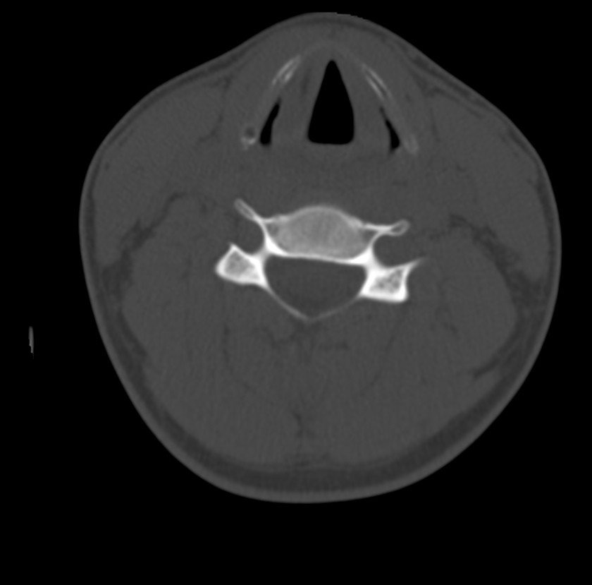Clay-shoveler fracture (Radiopaedia 22568-22590 Axial bone window 41).jpg