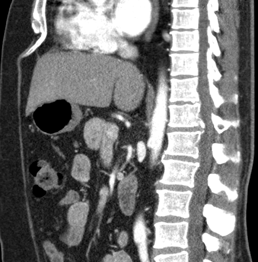 File:Clear cell renal cell carcinoma (Radiopaedia 61449-69393 D 57).jpg