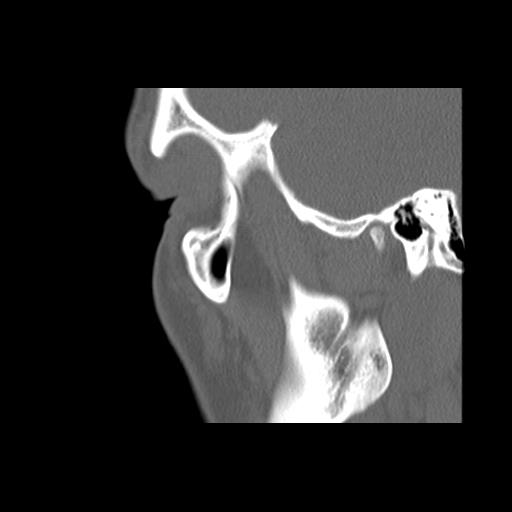 Cleft hard palate and alveolus (Radiopaedia 63180-71710 Sagittal bone window 12).jpg