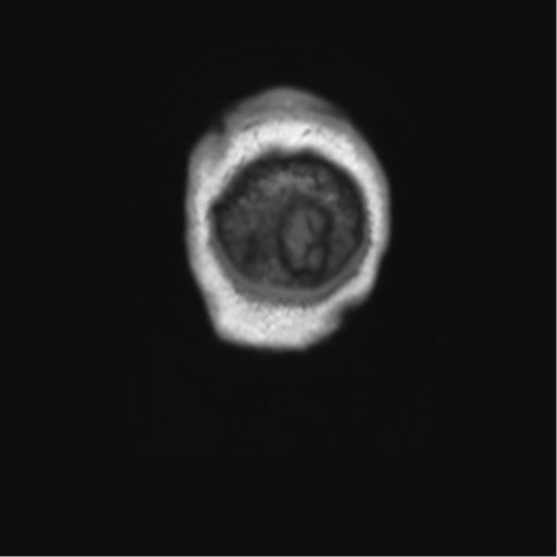 Clival chordoma invading the hypoglossal canal (Radiopaedia 48850-53887 Coronal T1 3).png