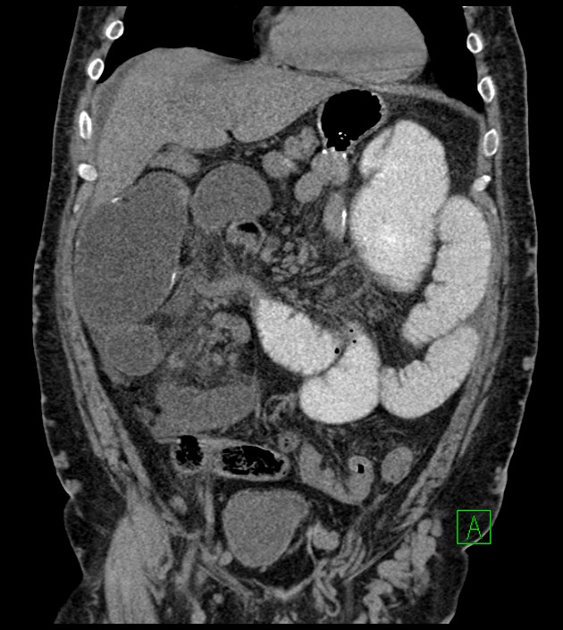 Closed-loop small bowel obstruction-internal hernia (Radiopaedia 78439-91096 Coronal non-contrast 39).jpg