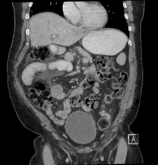 File:Closed loop obstruction - internal hernia into nephrectomy bed (Radiopaedia 59867-67320 B 48).jpg