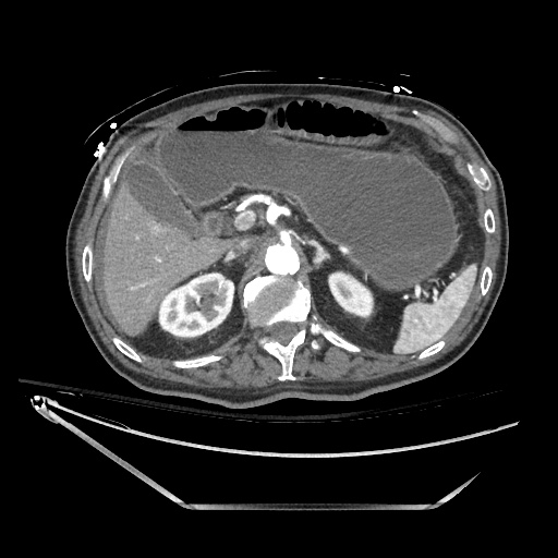Closed loop obstruction due to adhesive band, resulting in small bowel ischemia and resection (Radiopaedia 83835-99023 B 46).jpg