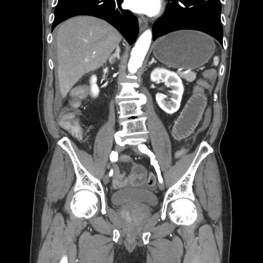 Closed loop obstruction due to adhesive band, resulting in small bowel ischemia and resection (Radiopaedia 83835-99023 C 72).jpg