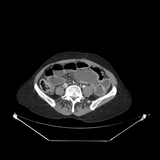 Closed loop small bowel obstruction (Radiopaedia 68471-78022 A 47).jpg